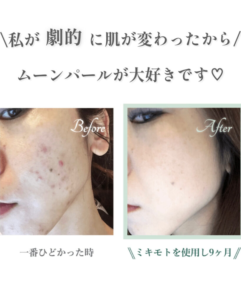 ムーンパールを使う前（ニキビが一番ひどかった時）と、使いはじめて9か月後の肌